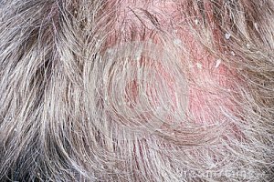 courtesy of http://www.dreamstime.com/royalty-free-stock-image-dandruff-bald-gray-hair-growing-elderly-man-concept-macro-selectice-focus-image30331446
